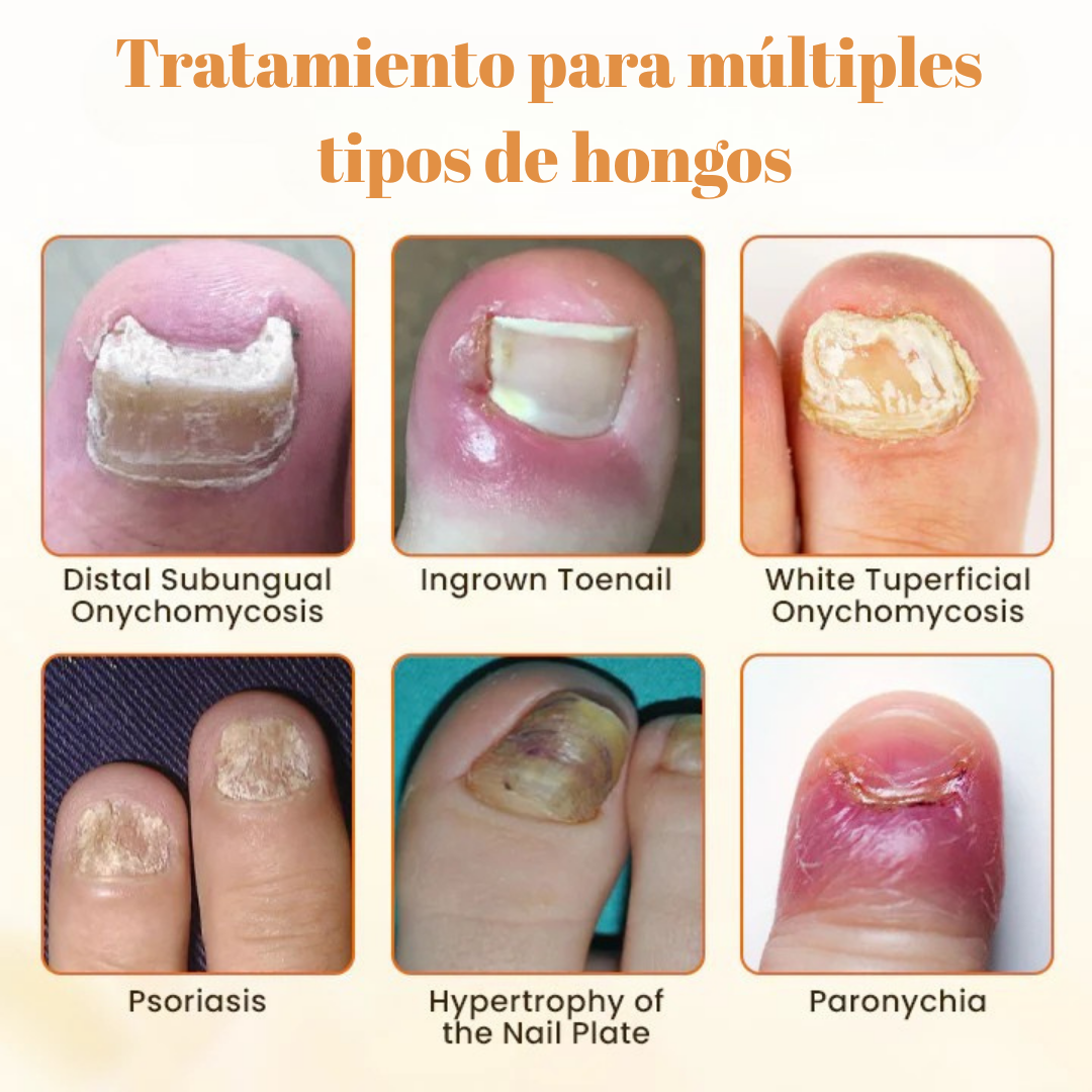 Removedor Hongos y reparador Avanzado de Uñas 7 días base jengibre