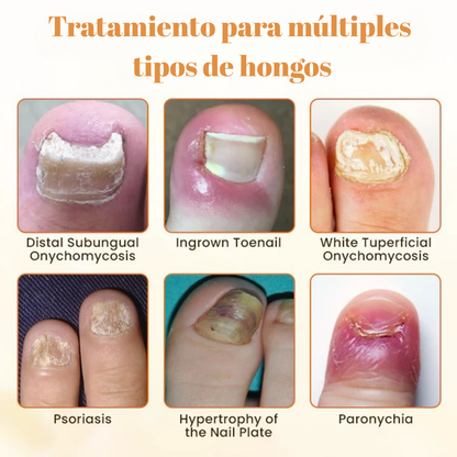 Removedor Hongos y reparador Avanzado de Uñas 7 días base jengibre