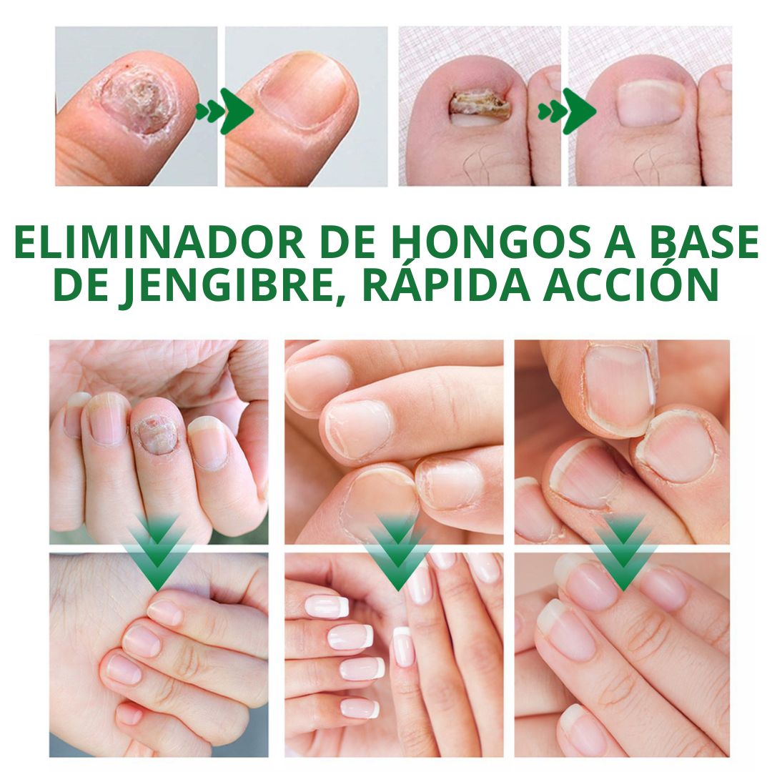 Removedor Hongos y reparador Avanzado de Uñas 7 días base jengibre