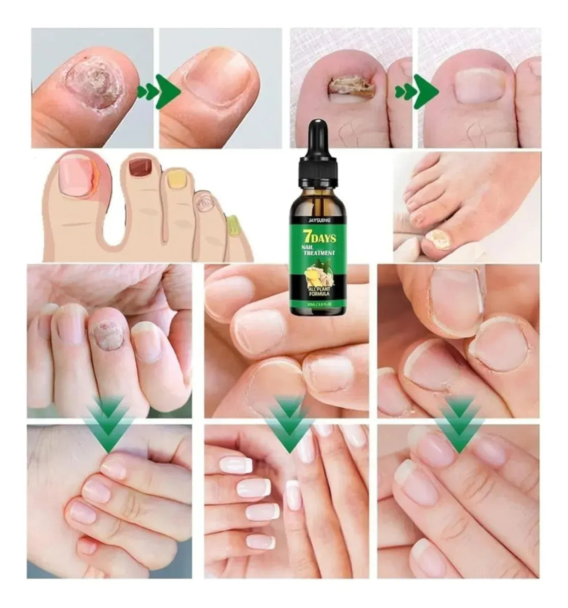 Removedor Hongos y reparador Avanzado de Uñas 7 días base jengibre